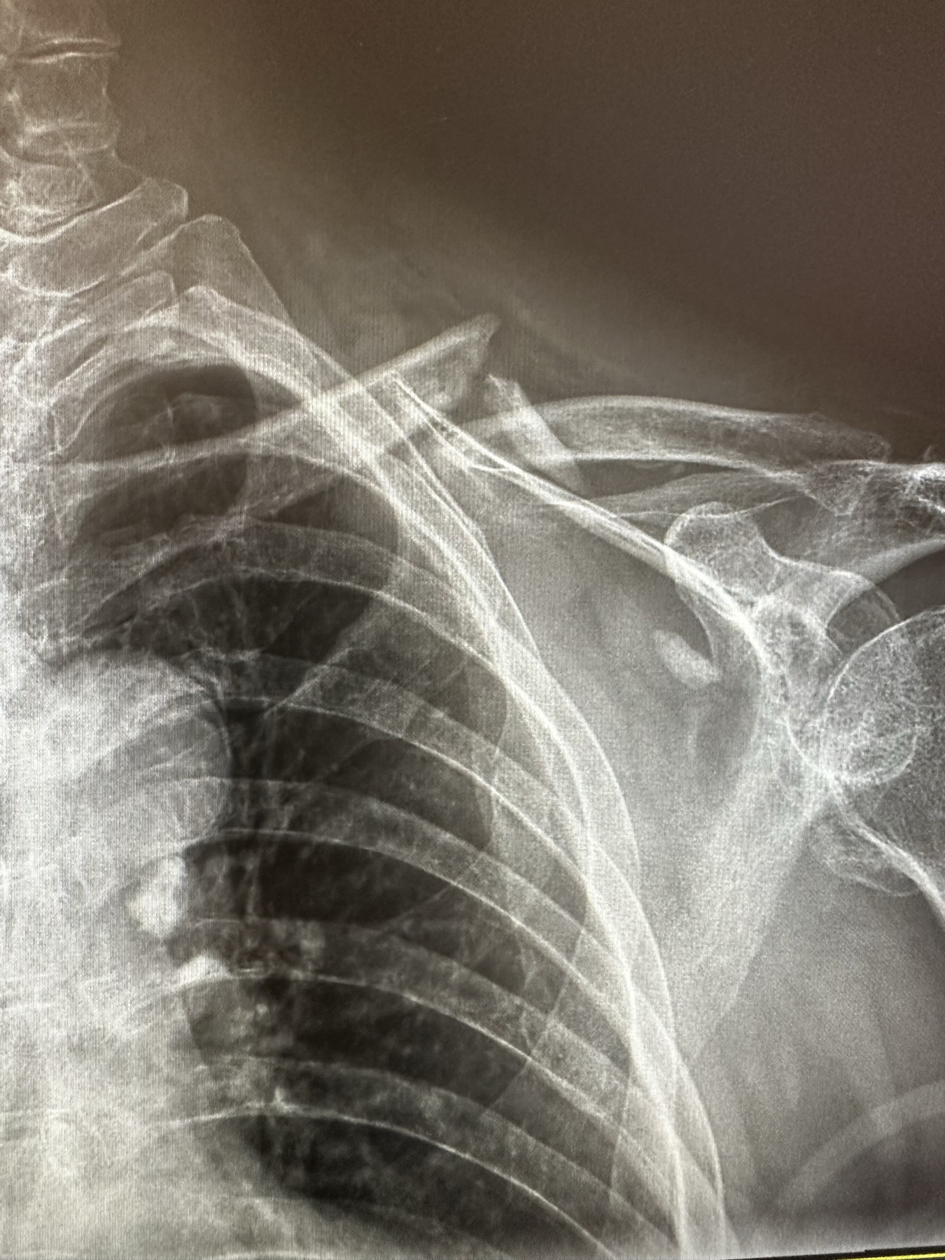 Clavicle fracture diagnosed by on-site X-ray at Wilshire Center Chiropractic
