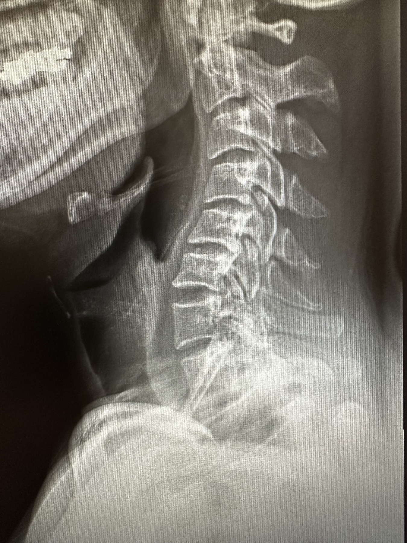 On-site cervical X-ray showing reverse curve at Wilshire Center Chiropractic