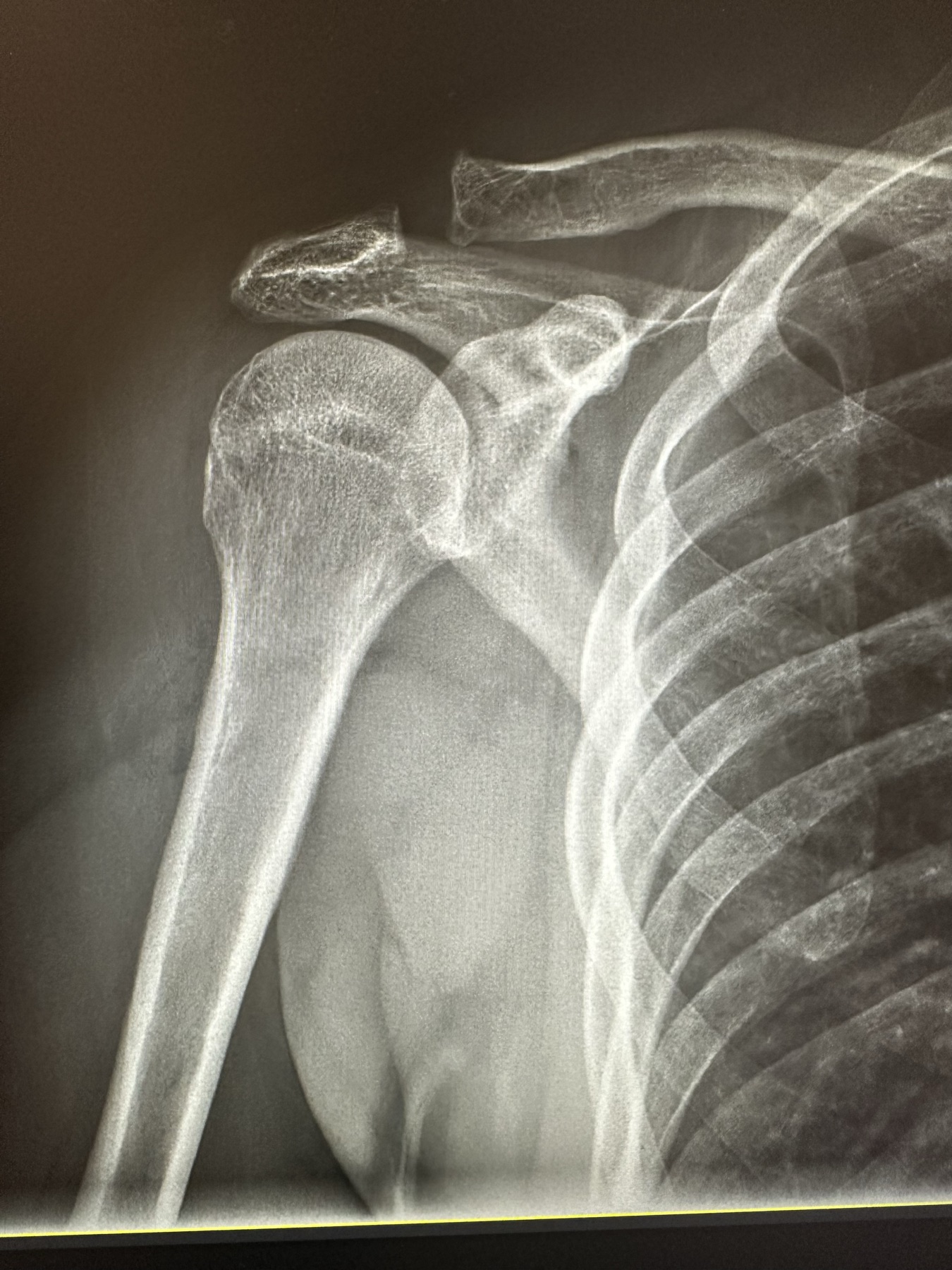 Shoulder AC joint separation visible on on-site X-ray at Wilshire Center Chiropractic